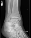 July 2018 Update – Broken Ankle